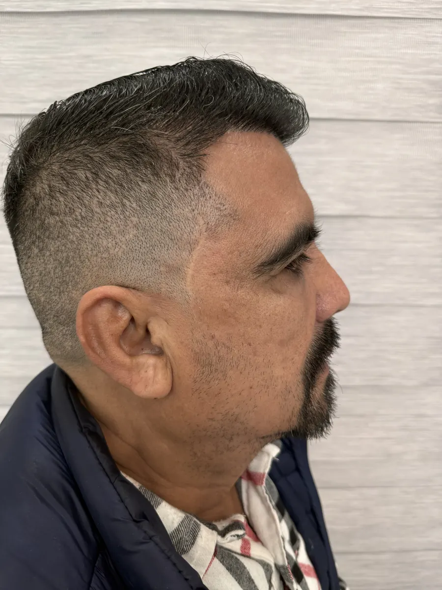 Perfil de paciente con barba poco poblada en las mejillas