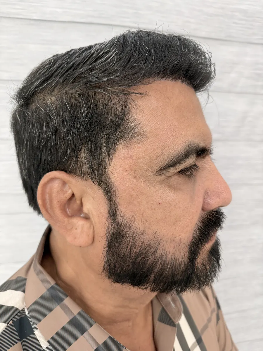 Perfil del mismo paciente con barba densa tras el injerto