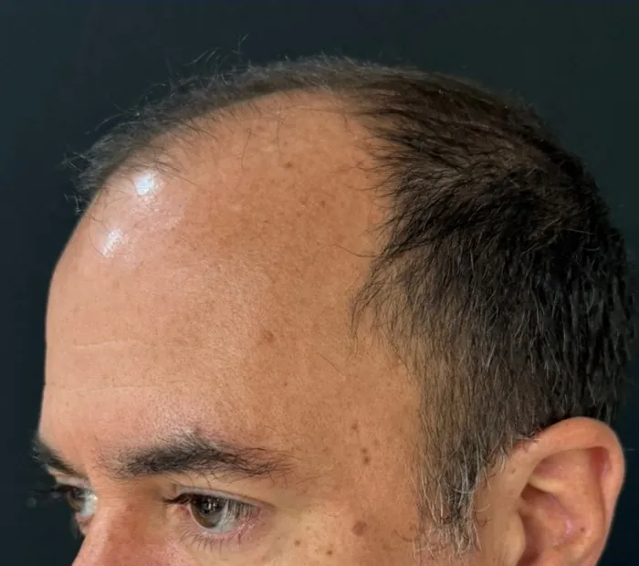 Línea frontal y entradas antes del injerto, detalle de frente y cuero cabelludo