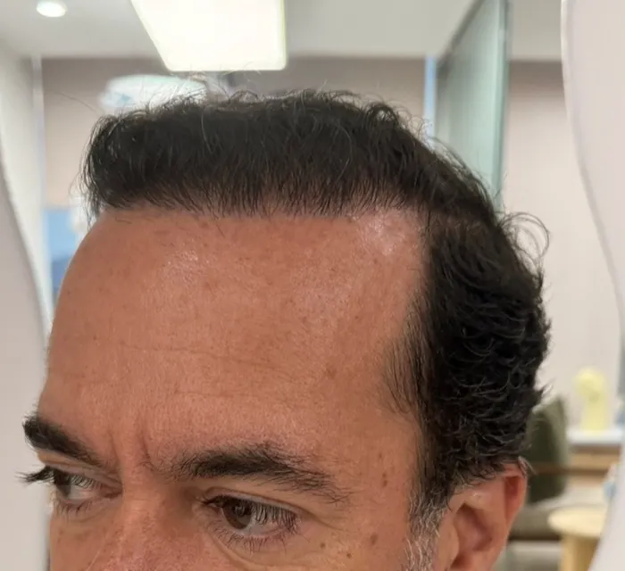 Línea frontal cerrada después del injerto, detalle de frente y cuero cabelludo