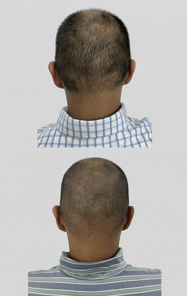 Antes y después de un injerto capilar, vista posterior de la zona donadora