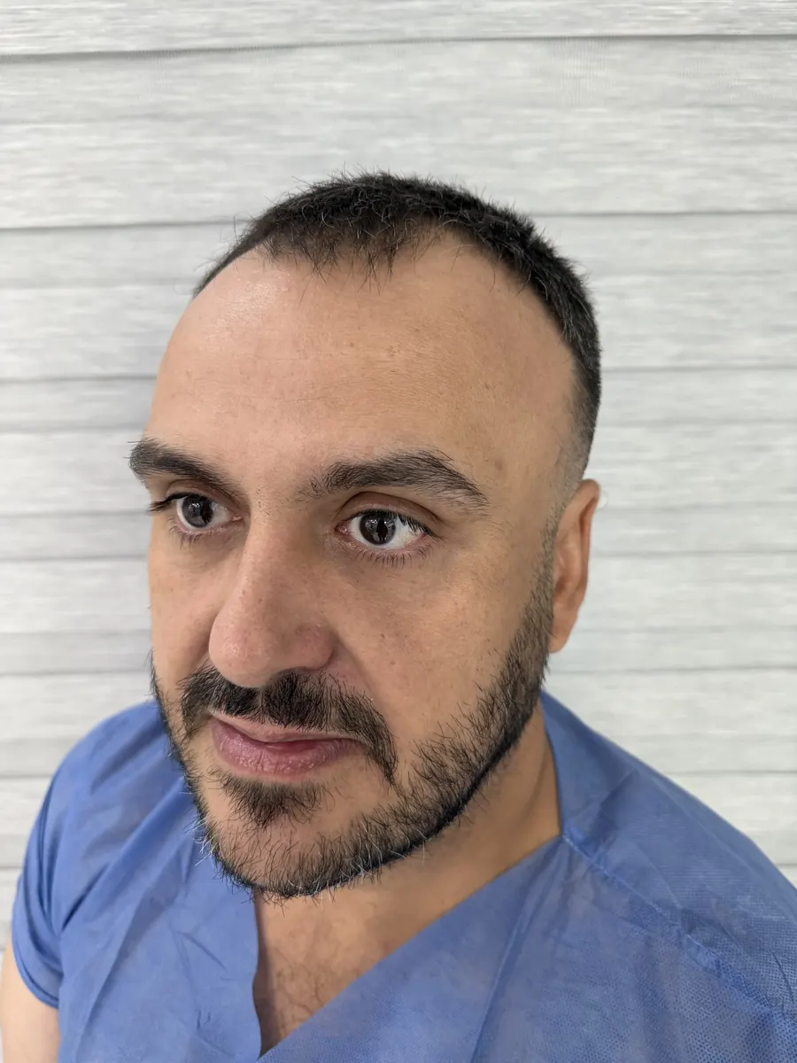 Paciente antes del injerto, con entradas marcadas y área frontal despoblada
