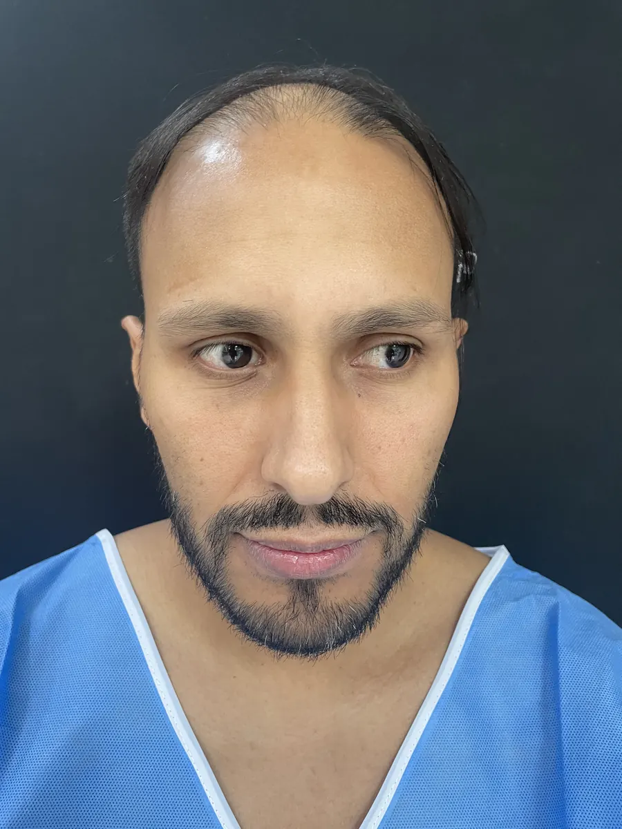 Paciente con entradas profundas y línea frontal retraída, candidato a megasesión