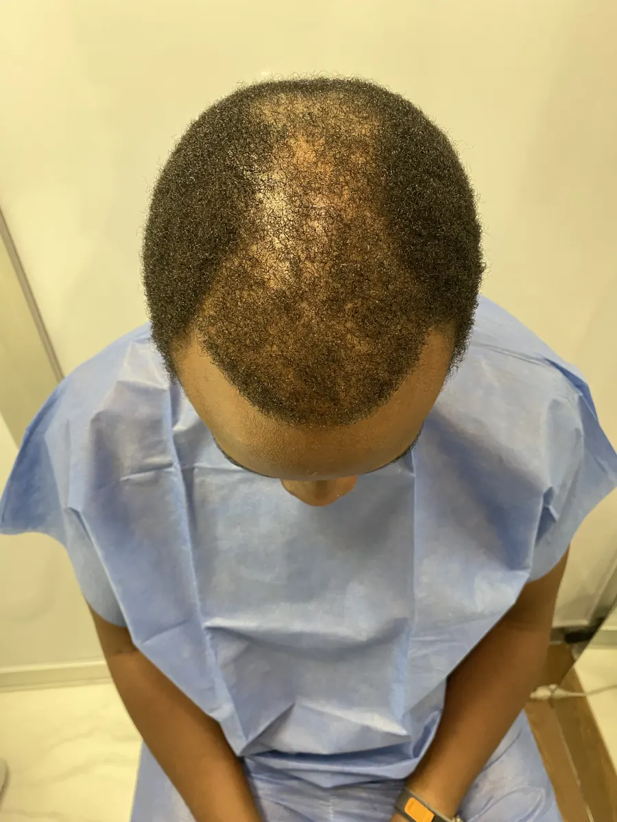 Vista superior de paciente con cabello rizado y entradas profundas, antes del injerto