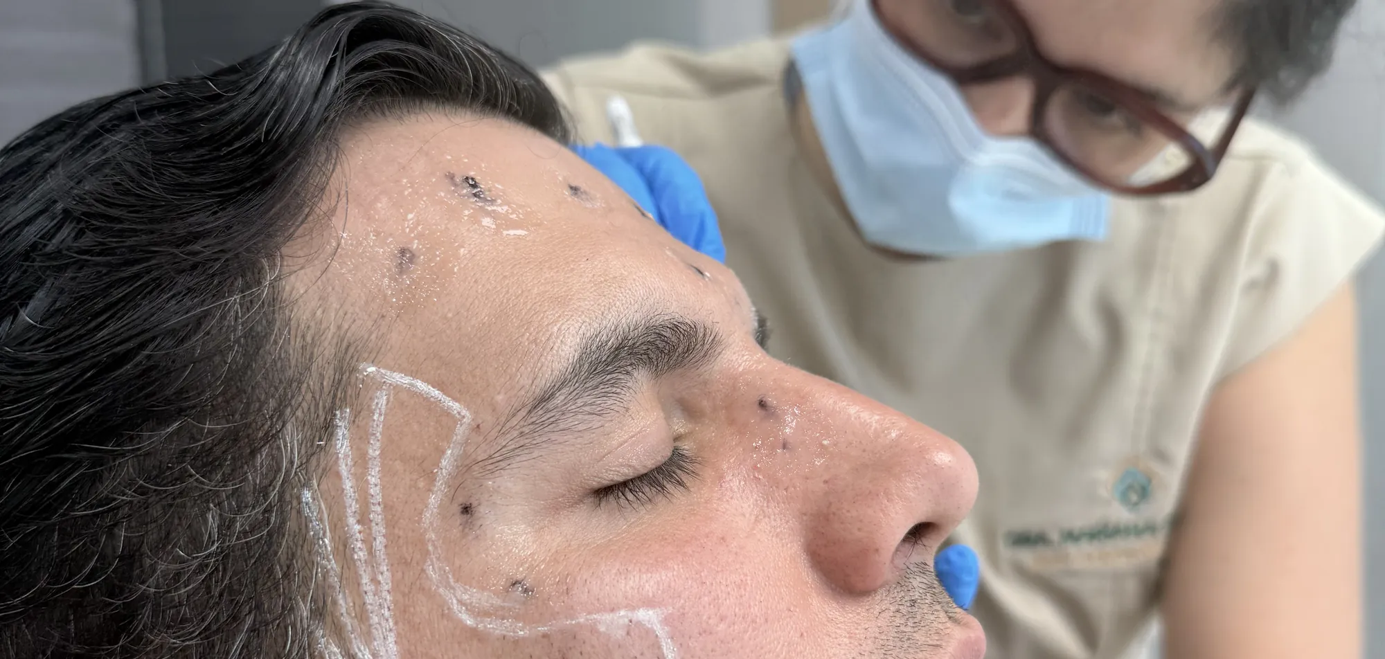 La Dra. Mariana Serratos aplicando Sculptra siguiendo el marcaje facial