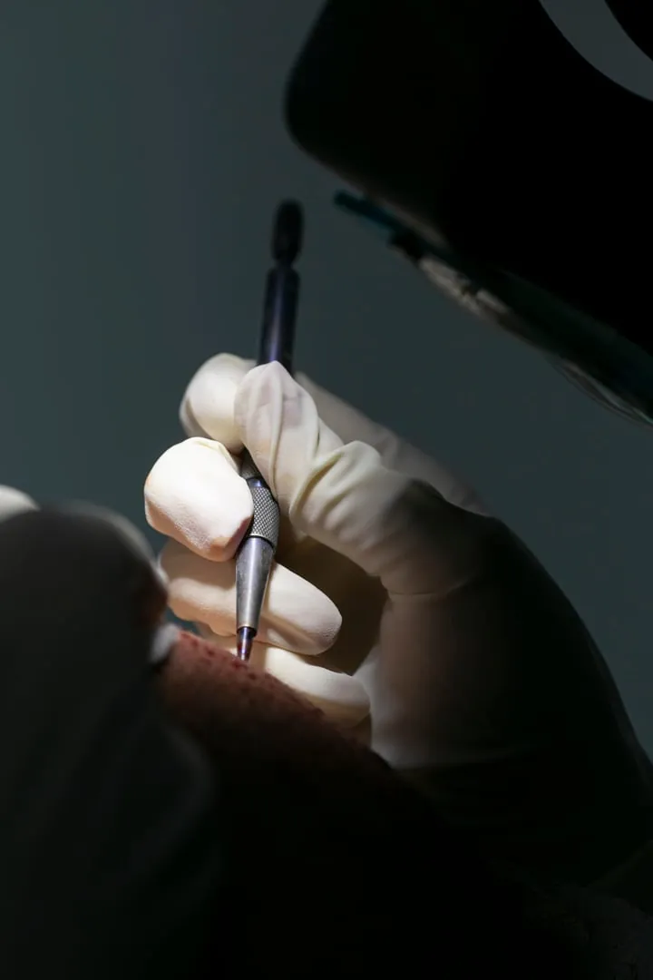 Detalle del punch de extracción durante la toma de unidades foliculares