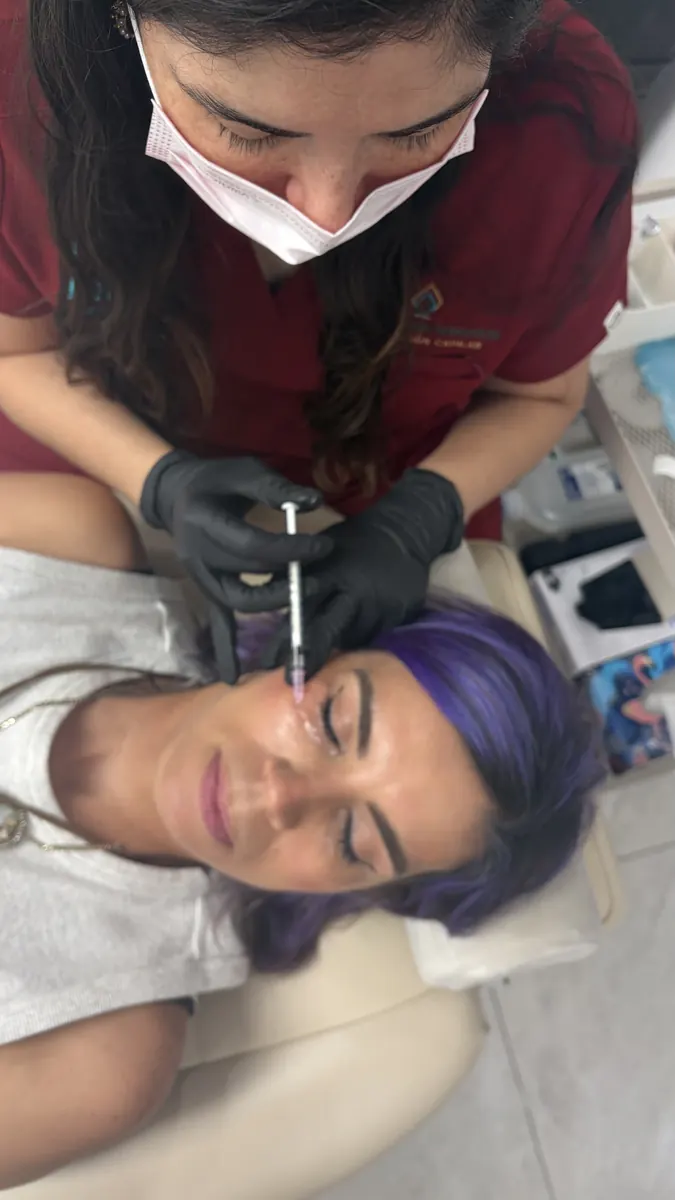 Aplicación de NCTF en el contorno de ojos para tratar ojeras